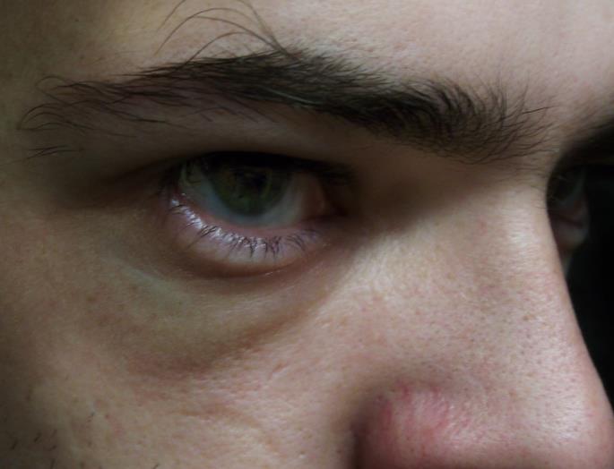 是什么导致眼袋(眼袋的治疗方法)