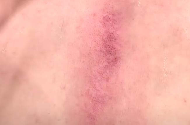 后背一推就出痧是什么原因(后背用手推出痧是怎么回事)