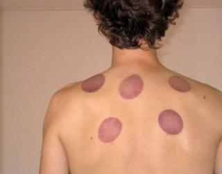 为什么年轻人不要拔罐(为什么不建议年轻人拔罐)