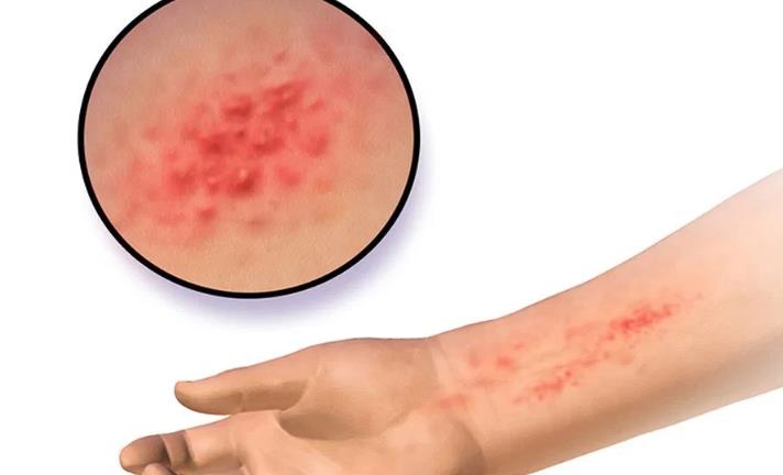 什么样的精油可以帮助摆脱热疹(痱子)?