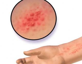 什么样的精油可以帮助摆脱热疹（痱子）?