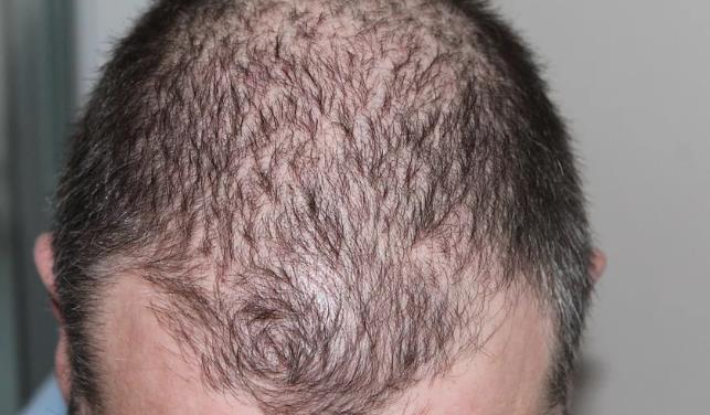 掉头发是什么原因(脱发是什么原因引起的)