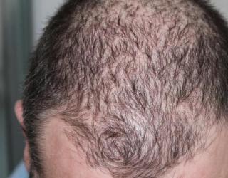 掉头发是什么原因（脱发是什么原因引起的）